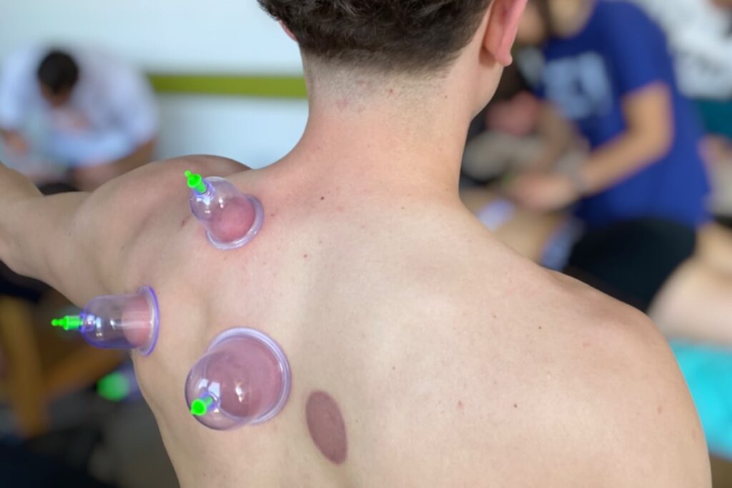 cupping spalla